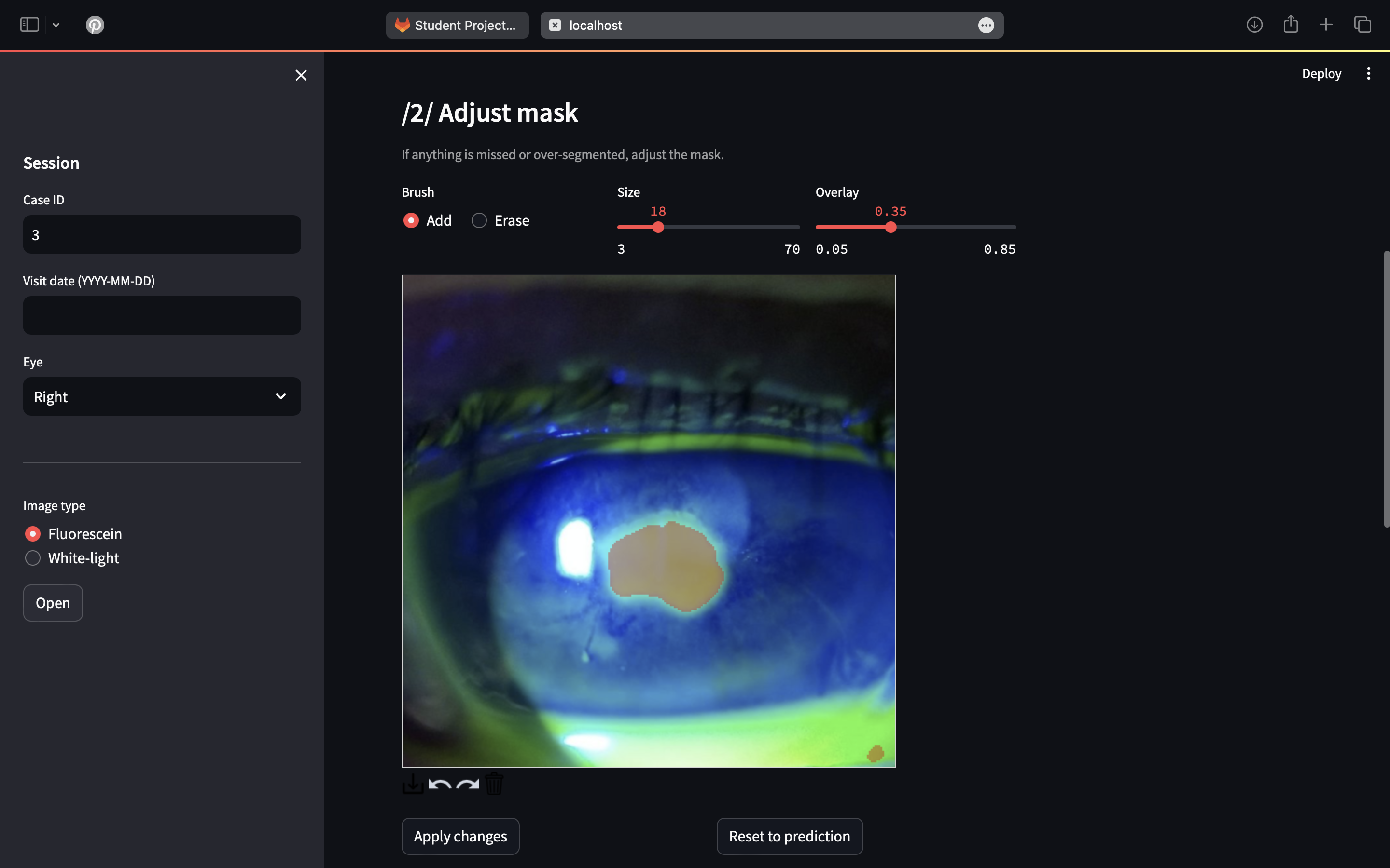 Preview of Douaa Ghezali's university corneal ulcer assessment application interface.
